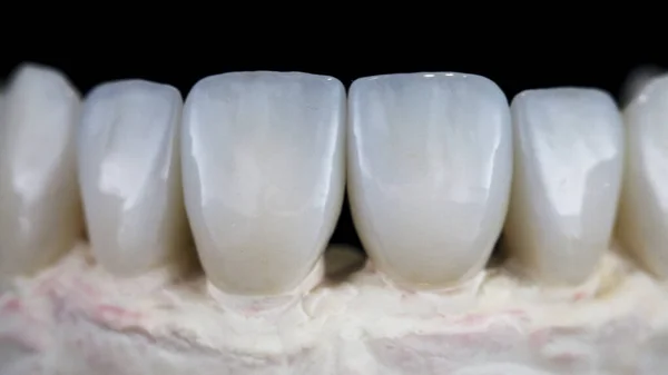 Makro Zdjęcie Oklein Dentystycznych Modelu Gipsowym — Zdjęcie stockowe