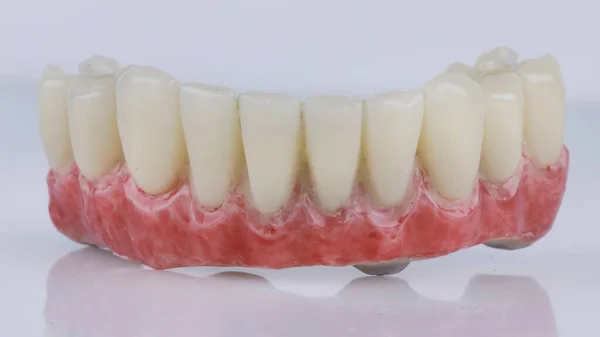 Protesi Dentaria Temporanea Realizzata Polimero Alta Qualità Mascella Inferiore Dopo — Foto Stock