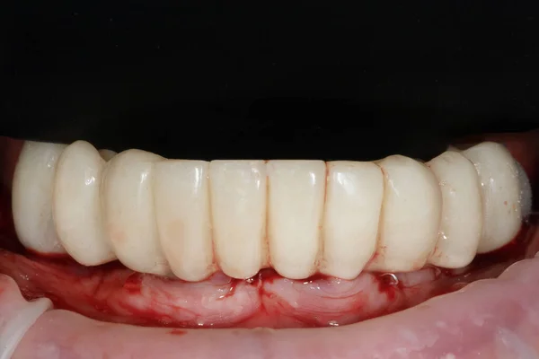 Υψηλής Ποιότητας Οδοντοστοιχίες Από Πολυμερές Πλαστικό — Φωτογραφία Αρχείου