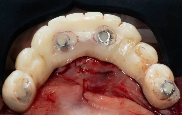 Prótese Dentária Definir Tempo Polímero Após Iplantatsii — Fotografia de Stock