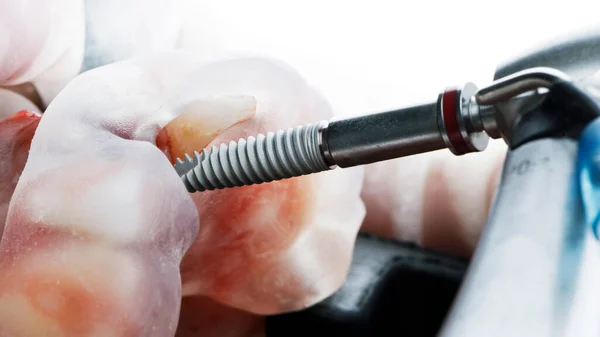 Impianto Dentale Modello Chirurgico Installazione Del Paziente — Foto Stock