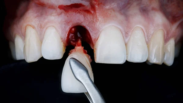 Extração Dentária Central Utilizando Instrumento Dentário — Fotografia de Stock