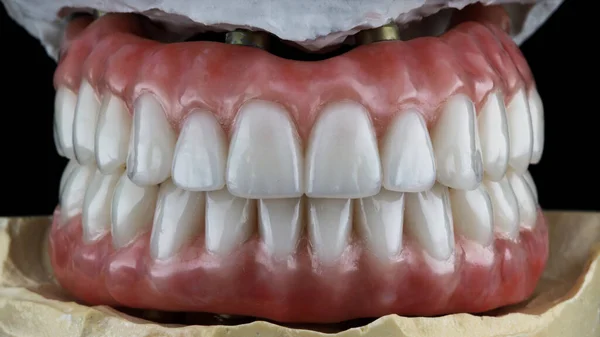 口の中の歯科モデルの下顎と上顎の高品質な歯列矯正 — ストック写真