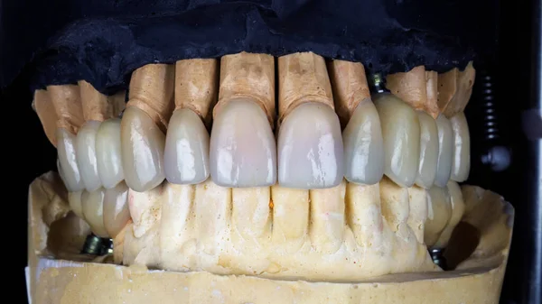 Ultradunne Fineerlagen Keramische Kronen Voor Tandheelkundige Modellen — Stockfoto