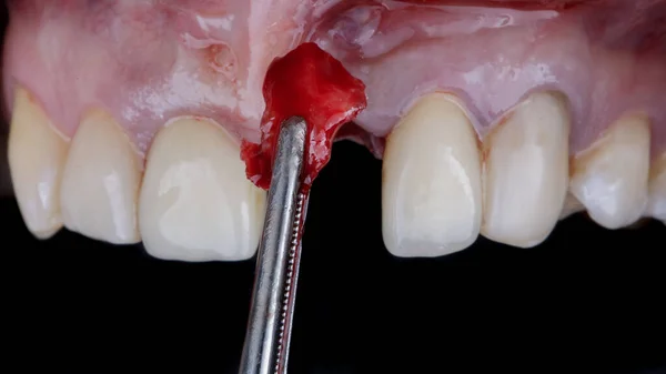 歯の移植前の骨の断片 — ストック写真