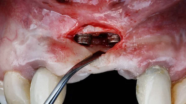 歯肉腔に埋め込まれた2つのインプラントは — ストック写真