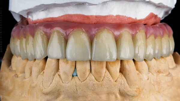 Proteza Zębów Górnej Szczęki Modelu Naturalnym Ugryzieniu Czarnym Tle — Zdjęcie stockowe