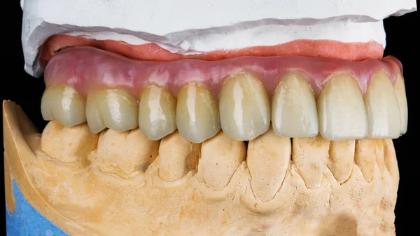 Prótese Dentária Qualidade Para Mandíbula Superior Modelo Reticulado — Fotografia de Stock