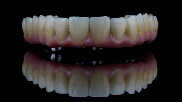 6本のインプラントを固定するためのピンクのガムで作られたセラミック製の審美的な歯科補綴物 — ストック写真