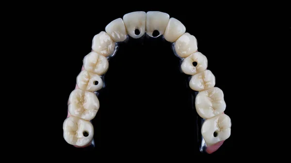 Prótese Dentária Feita Titânio Com Coroas Cerâmica Bonita Alta Qualidade — Fotografia de Stock