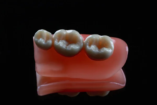 Modello Tre Denti Con Gomma Artificiale Sparato Uno Sfondo Nero — Foto Stock