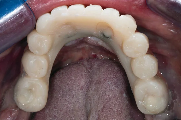 Dentadura Fija Cavidad Oral —  Fotos de Stock