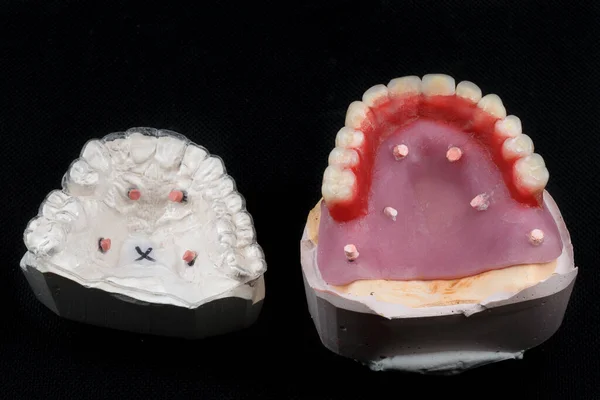 Especial Para Modelo Dental Kappa Prótesis Cerámica —  Fotos de Stock