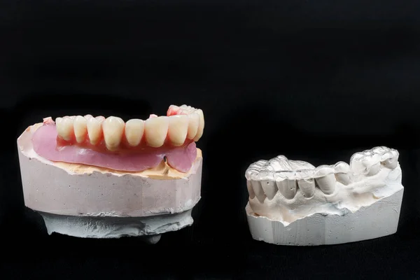 Especial Para Kappa Modelo Dental Prótesis Cerámica Disparado Ángulo Con —  Fotos de Stock