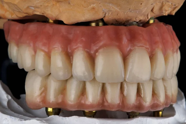 Prótesis Dentales Naturales Alta Calidad Con Goma Rosa Circonio Cerámica —  Fotos de Stock