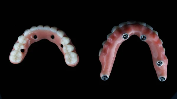 Alt Üst Çene Için Yüksek Kaliteli Diş Protezleri Siyah Arkaplan — Stok fotoğraf