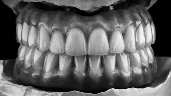 Duas Próteses Dentárias Alta Qualidade Mandíbula Inferior Superior Sobre Modelo — Fotografia de Stock