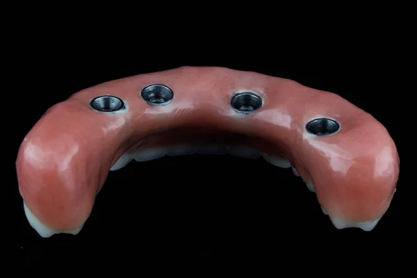 Wysokiej Jakości Proteza Stomatologiczna Dolnej Szczęki Różową Gumą Jest Usuwana — Zdjęcie stockowe