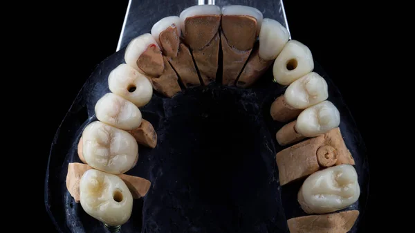Folheados Dentários Finos Coroas Cerâmica Modelo Dental Vista Superior — Fotografia de Stock