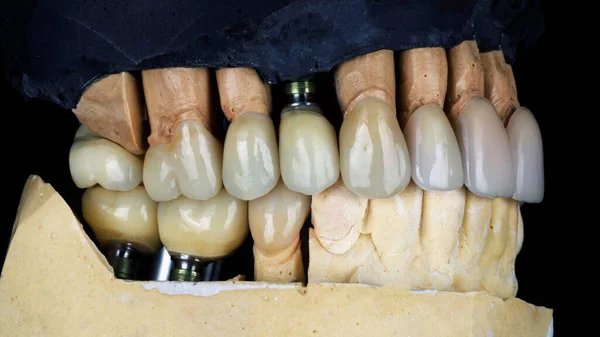 Folheados Coroas Cerâmica Modelo Dental Vista Lateral Sobre Fundo Preto — Fotografia de Stock