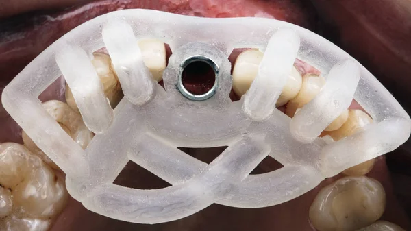 Szablon Chirurgii Stomatologicznej Implantacji Przednich Zębów — Zdjęcie stockowe