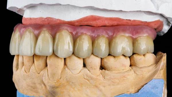 Prótese Dentária Alta Qualidade Para Mandíbula Superior Modelo Gesso Vista — Fotografia de Stock