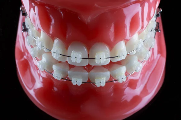Modello Dentale Qualità Con Bretelle Girato Sfondo Nero — Foto Stock