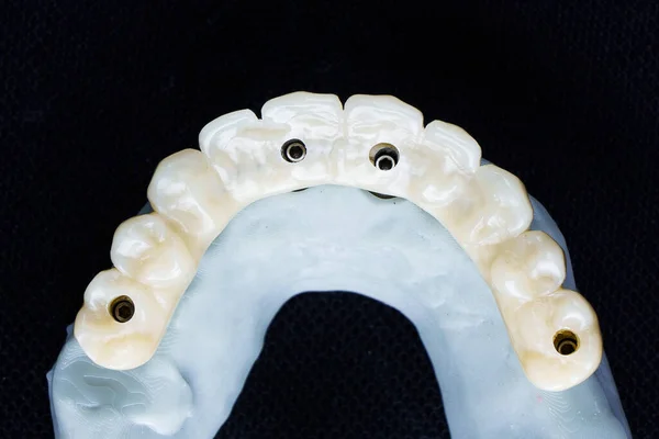 Denture Ceramics High Quality Dental Model Photographed Black Background — Stock Photo, Image