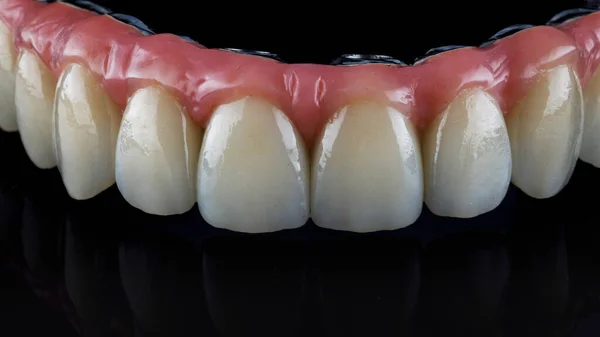 Makro Fotografie Zubní Protézy Růžovou Gumou Záběr Černém Pozadí — Stock fotografie