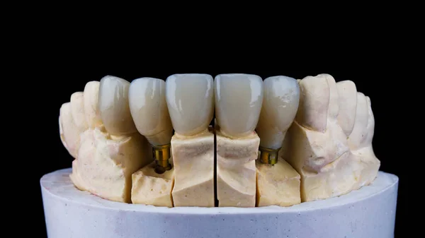 Tres Chapas Alta Calidad Dos Coronas Para Modelos Dentales —  Fotos de Stock