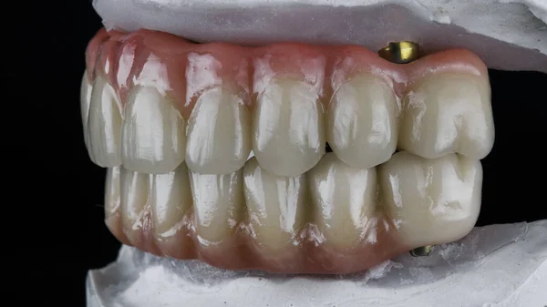 Dwie Protezy Dentystyczne Wykonane Ceramiki Różową Gumą Modelu Dentystycznym Widok — Zdjęcie stockowe