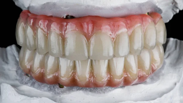 Duas Próteses Dentárias Confeccionadas Cerâmica Com Goma Rosa Confeccionadas Modelo — Fotografia de Stock