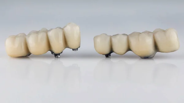 Puentes Prótesis Dentales Temporales Plástico Dental Especial Sobre Fondo Blanco —  Fotos de Stock