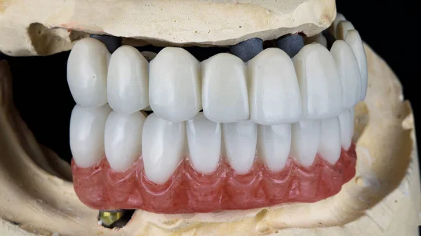 石膏の模型の上にポリマーで作られた一時的な歯科用義歯 — ストック写真
