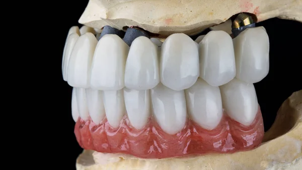 Próteses Dentárias Bonitas Feitas Polímero Modelo Gesso — Fotografia de Stock