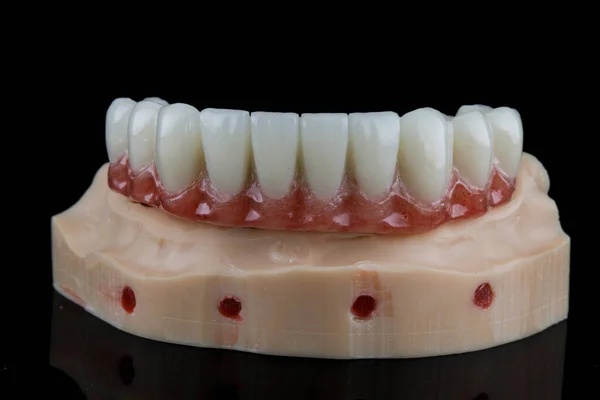 3Dプリンタで作成されたモデルにピンクのガムで下顎の一時的な歯科補綴物 — ストック写真