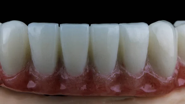 Foto Close Een Tandprothese Van Polymeer Met Een Roze Gom — Stockfoto