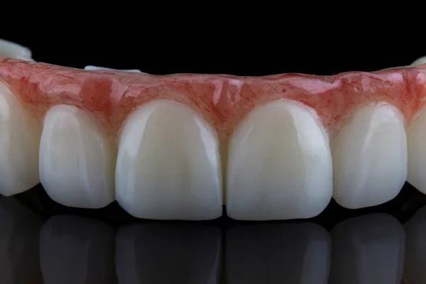 Tymczasowa Proteza Zębów Zbliżenie Czarnym Tle — Zdjęcie stockowe