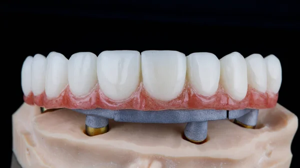 Özel Bir Diş Kirişinde Üst Çenenin Makro Fotoğrafı Yazıcıda Yapılmış — Stok fotoğraf