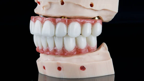 Prótesis Dentales Para Costra Inferior Superior Del Paciente Modelo —  Fotos de Stock