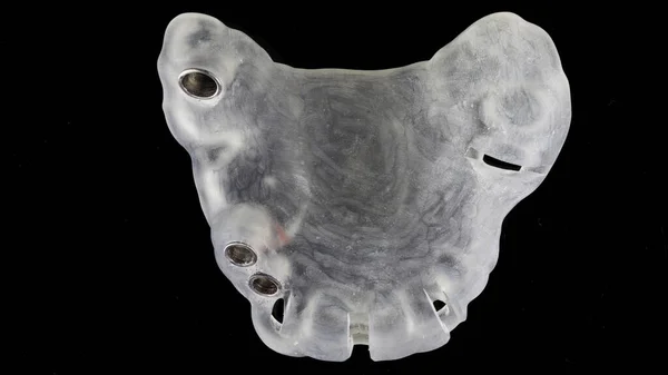Molde Cirúrgico Para Implantação Três Implantes Dentários Para Defeito Final — Fotografia de Stock