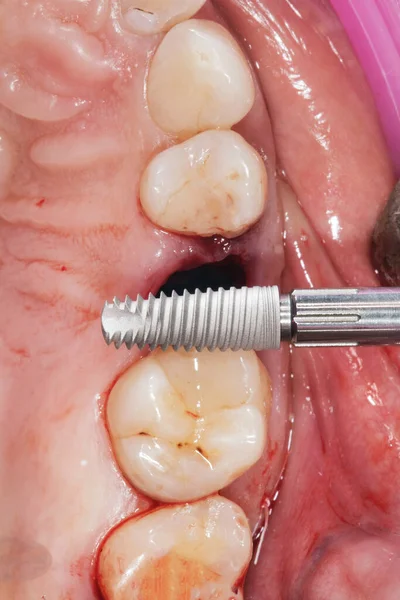 Çekilen Diş Nakledilmeden Önce Implantın Görüntüsü — Stok fotoğraf
