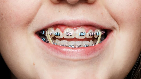 smiling teenage girl with braces and colored rubber bands