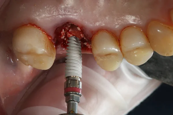 7番目の歯へのインプラントと人工歯茎の追加 — ストック写真