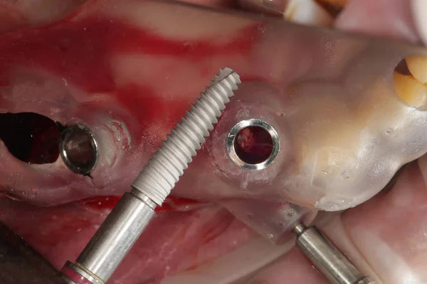 Impianto Dentale Modello Chirurgico Una Precisione — Foto Stock
