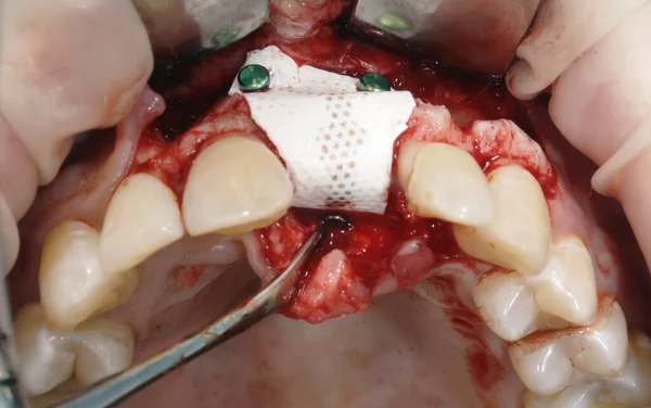 Ποιότητα Οδοντική Μεμβράνη Για Την Αύξηση Των Μαλακών Ιστών — Φωτογραφία Αρχείου