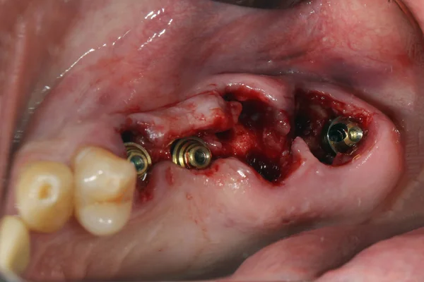 歯茎の中に3本の真っ直ぐなマルチユニタがあり — ストック写真