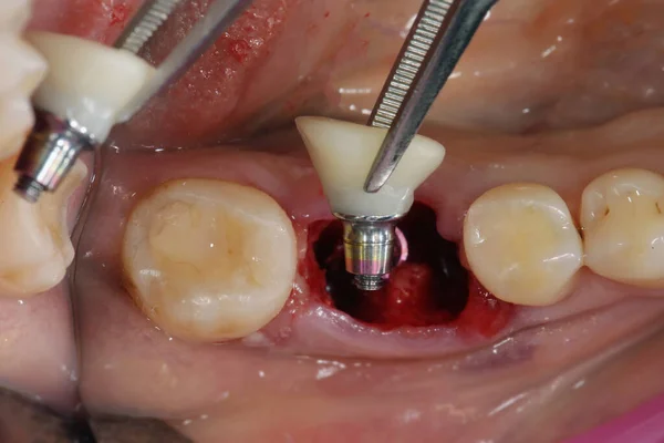 移植後の歯を噛む仮冠 — ストック写真