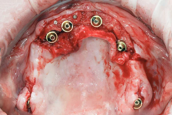 Seis Implantes Multiyunita Rectos Definidos Durante Gran Cirugía Dental —  Fotos de Stock
