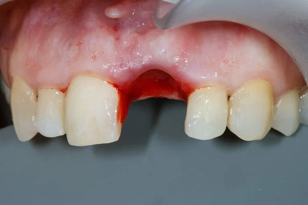 Dente Frontal Remoto Cortador Preparação Para Implantação — Fotografia de Stock